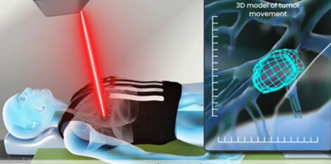 身体のわずかな動きによる腫瘍の位置ズレもリアルタイムで補正