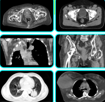 内蔵CTで照射前に画像確認